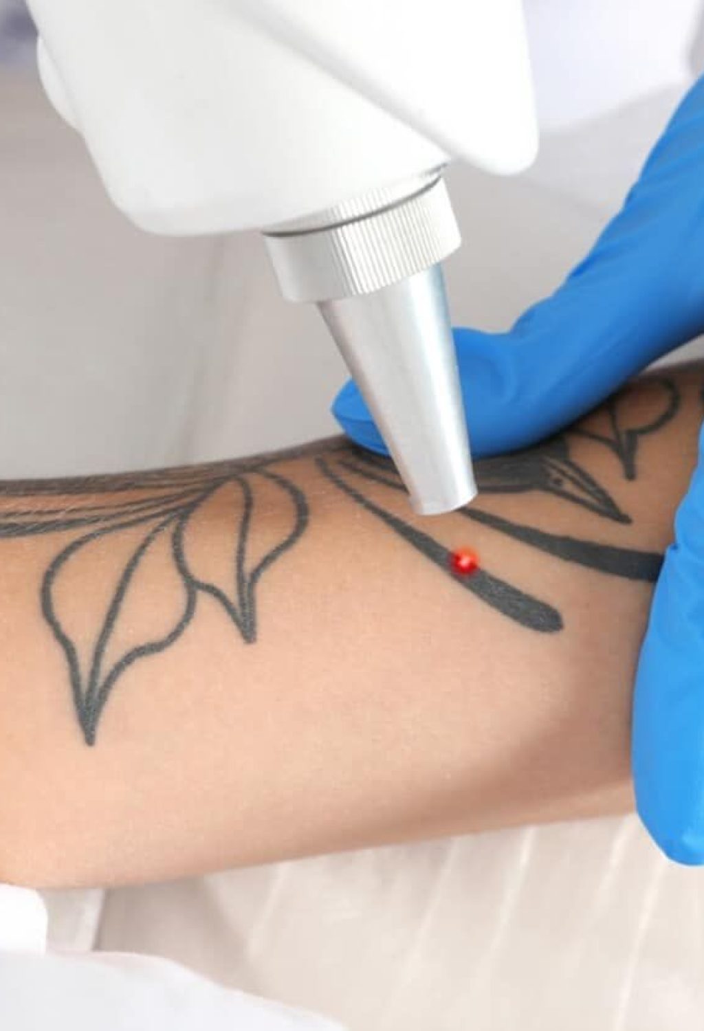 Laser tattoo removal